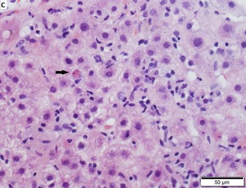 Acute hepatitis C virus