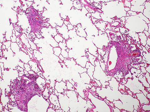 Lung_-_Miliary_tuberculosis_(6545822817)
