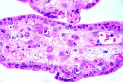 Cytomegalovirus_(CMV)_Placentitis