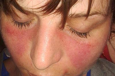 Butterfly erythema in systemic lupus