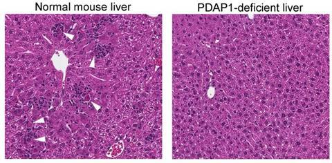 (Left) Liver cells infected with hepatitis A. The white arrows show areas with dying liver cells surrounded by inflammatory cells generated by the immune response to the virus. (Right) Liver cells infected with hepatitis A and lacking PDAP1.