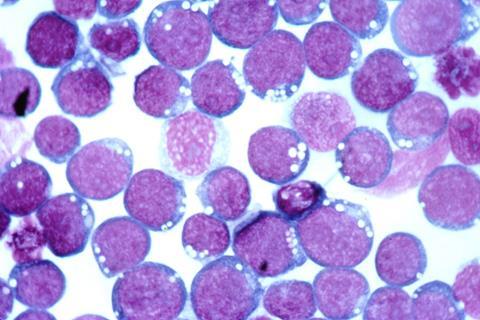 Epstein-barr_virus_(ebv)