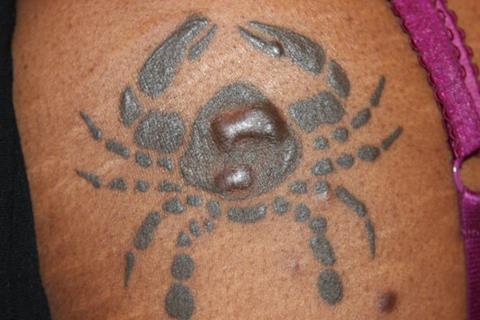 Tattoo_keloid