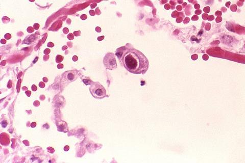 Cytomegalovirus_01