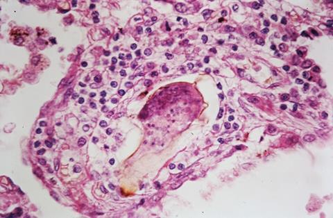 Schistosomiasis_(13383125494)