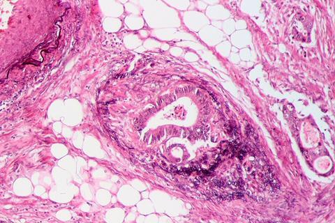 Tumor_invasion_into_vein_in_a_case_of_colorectal_cancer,_Elastica_stain_2
