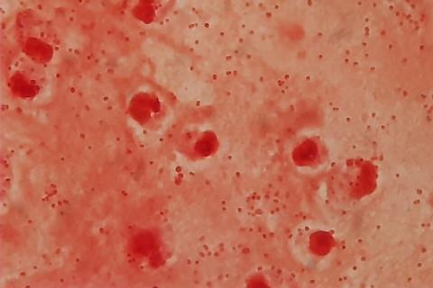 Gram_negative_coccobacilli_of_Acinetobacter_in_bronchoalveolar_lavage_(BAL)_Gram_staining (1)