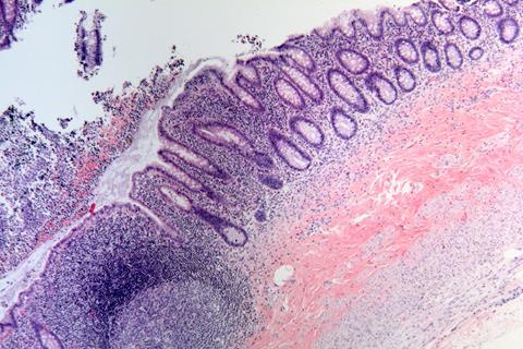 Acute appendicitis histology image