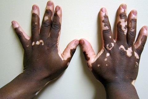 Vitiligo2
