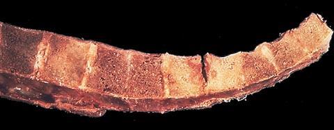 Tuberculosis_of_spinal_column_(6539943165)