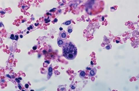 Cytomegalovirus_infection_(3786798300)