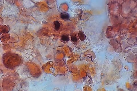 Pneumococcus_in_Gram-Stained_BAL_Sample (1)