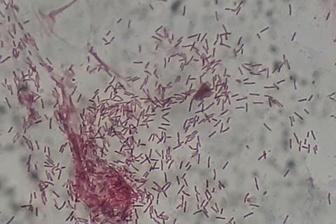 Gram_negative_rods_(GNRs)_of_Pseudomonas_aeruginosa_in_Gram_staining_of_BAL (1)