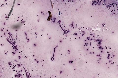 Onchocerca_volvulus_(YPM_IZ_093383)