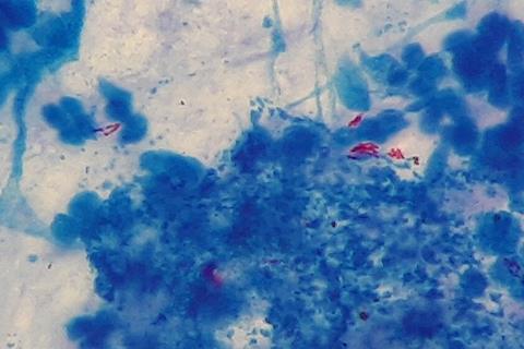 Mycobacterium_tuberculosis_in_Ziehl-Neelsen_stained_smear_of_sputum (1)