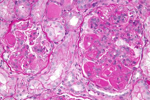 Diffuse_proliferative_lupus_nephritis_-a-_very_high_mag