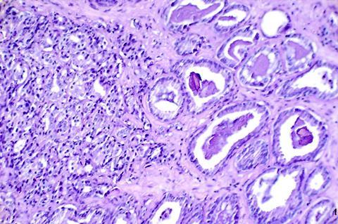 800px-Prostate_cancer_(1)