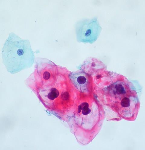 CIN_1-HPV_on_ThinPrep