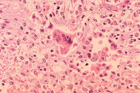 Measles_pneumonia_-_Histopathology