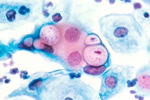 800px-Pap_smear_showing_clamydia_in_the_vacuoles_500x_H&E