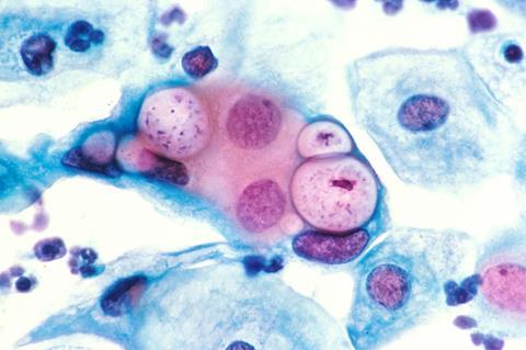 800px-Pap_smear_showing_clamydia_in_the_vacuoles_500x_H&E (1)