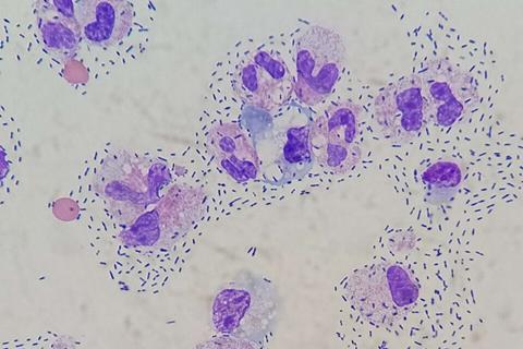 Cerebrospinal_fluid_differential_in_bacterial_meningitis_-_Wright-Giemsa_stain (1)