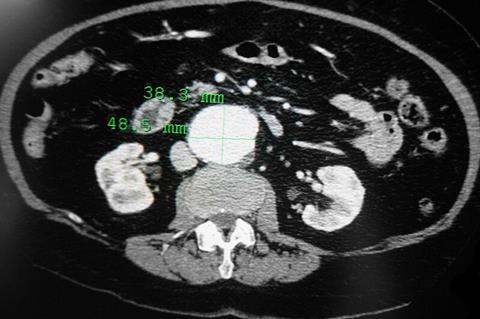 Contrast-enhanced_CT_scan_demonstrating_abdominal_aortic_aneurysm (1)