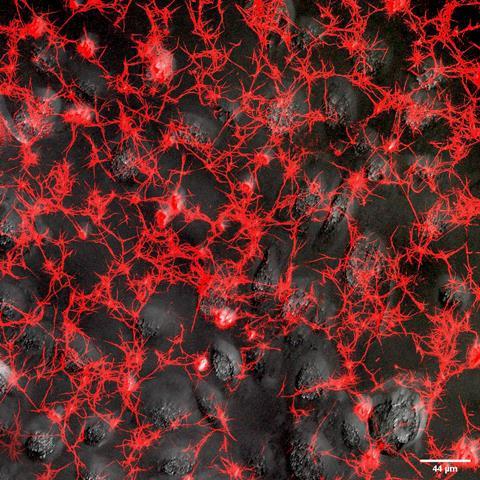 COVID-induced_Lung_Fibrosis_with_fibrin_deposits_(red)_associated_with_human_lung_epithelial_cells_infected_with_SARS-CoV-2