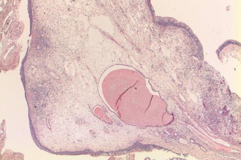 Nasal polyp H+E stain