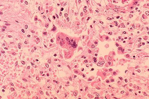 Measles_pneumonia_-_Histopathology (2)