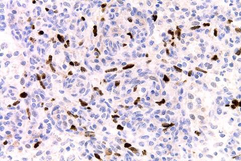 LANA-1_immunostain_in_a_Kaposi_sarcoma_in_a_patient_with_HHV8-associated_MCD