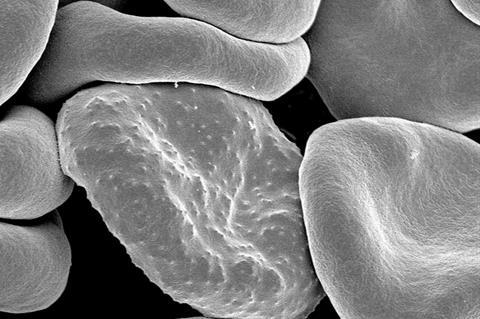 Red_blood_cells_infected_with_malaria
