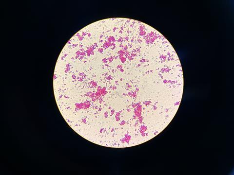 Nontuberculous_Mycobacteria_(NTM)_in_Ziehl-Neelsen_Staining_from_Positive_MGIT_Culture