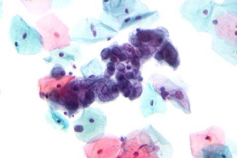 Herpes_simplex_virus_pap_test_2