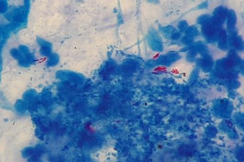 Mycobacterium_tuberculosis_in_Ziehl-Neelsen_stained_smear_of_sputum