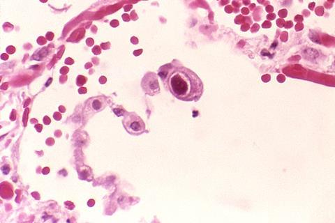 Cytomegalovirus_01
