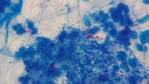 Mycobacterium_tuberculosis_in_Ziehl-Neelsen_stained_smear_of_sputum (1)