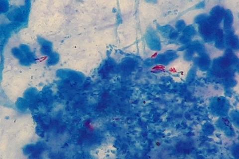Mycobacterium_tuberculosis_in_Ziehl-Neelsen_stained_smear_of_sputum