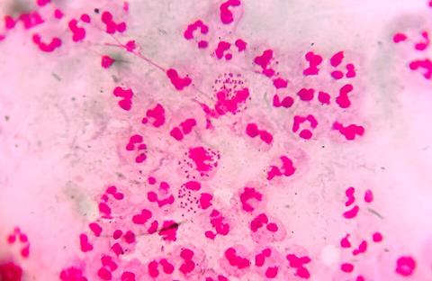 Neisseria_gonorrhoeae_in_urethral_discharge