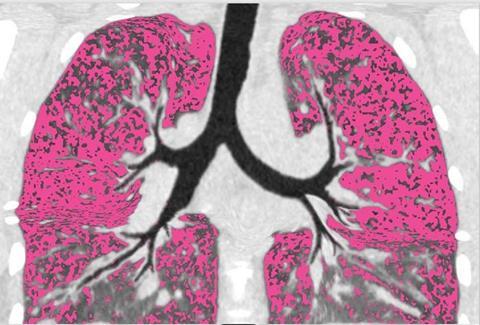 Low-Res_Cystic fibrosis air trapping in lung