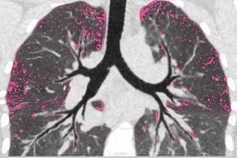Low-Res_Cystic fibrosis patient lungs after treatment