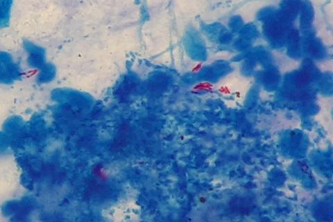 Mycobacterium_tuberculosis_in_Ziehl-Neelsen_stained_smear_of_sputum