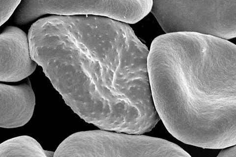 Red_blood_cells_infected_with_malaria
