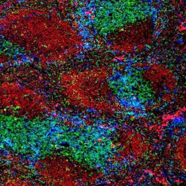 Characteristics of CD4+T-cell reduction and pulmonary infections in ...